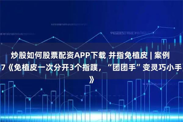 炒股如何股票配资APP下载 并指免植皮 | 案例 37《免植皮一次分开3个指蹼，“团团手”变灵巧小手》